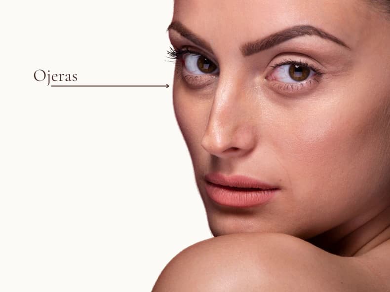 Relleno de ojeras: zona periocular