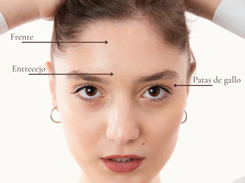 Toxina botulínica: zonas de aplicación — frente, entrecejo y patas de gallo